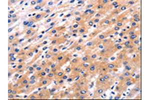The image on the left is immunohistochemistry of paraffin-embedded Human liver cancer tissue using ABIN7192110(RAB39A Antibody) at dilution 1/5, on the right is treated with synthetic peptide. (RAB39A 抗体)