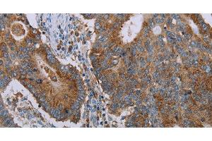 Immunohistochemistry of paraffin-embedded Human thyroid cancer tissue using CYP7A1 Polyclonal Antibody at dilution 1:30 (CYP7A1 抗体)