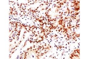 IHC testing of ovarian cancer stained with Estrogen Receptor beta antibody (ERb455). (ESR2 抗体  (C-Term))
