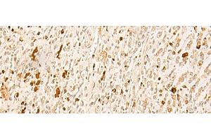 Immunohistochemistry of paraffin-embedded Human gastric cancer tissue using TBPL1 Polyclonal Antibody at dilution of 1:50(x200) (TBPL1 抗体)