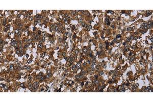 Immunohistochemistry of paraffin-embedded Human liver cancer tissue using HOMER2 Polyclonal Antibody at dilution 1:40 (HOMER2 抗体)