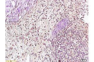 Formalin-fixed and paraffin embedded: human cervical carcinoma labeled with Anti-Runx3 Polyclonal Antibody (ABIN739370), Unconjugated at 1:300, followed by conjugation to the secondary antibody and DAB staining (RUNX3 抗体)