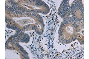 The image on the left is immunohistochemistry of paraffin-embedded Human colon cancer tissue using ABIN7191408(MARVELD1 Antibody) at dilution 1/40, on the right is treated with synthetic peptide.