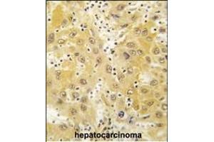 Formalin-fixed and paraffin-embedded human hepatocarcinoma tissue reacted with Tiparp antibody (N-term) (ABIN392513 and ABIN2842075) , which was peroxidase-conjugated to the secondary antibody, followed by DAB staining. (Tiparp 抗体  (N-Term))