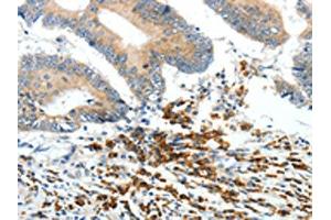 The image on the left is immunohistochemistry of paraffin-embedded Human colon cancer tissue using (PTEN Antibody) at dilution 1/20, on the right is treated with synthetic peptide. (PTEN 抗体)