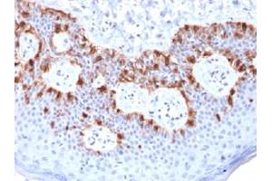 Immunohistochemical staining (Formalin-fixed paraffin-embedded sections) of human melanoma with MLANA recombinant monoclonal antibody, clone rMLANA/788 . (Recombinant MLANA 抗体)