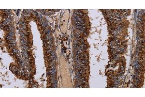 Immunohistochemistry of paraffin-embedded Human colon cancer tissue using PPP1R1B Polyclonal Antibody at dilution 1:50 (DARPP32 抗体)