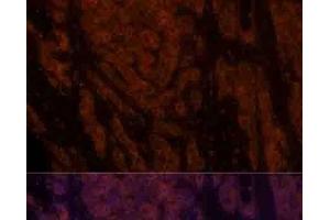 Immunofluorescence analysis of Human liver cancer using CXCL12 Polyclonal Antibody at dilution of 1:100. (CXCL12 抗体)