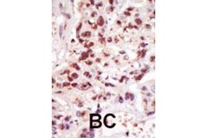 Formalin-fixed and paraffin-embedded human cancer tissue reacted with MAP3K8 polyclonal antibody  , which was peroxidase-conjugated to the secondary antibody, followed by DAB staining. (MAP3K8 抗体  (C-Term))