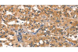 Immunohistochemistry of paraffin-embedded Human thyroid cancer using EIF4G1 Polyclonal Antibody at dilution of 1:30 (EIF4G1 抗体)