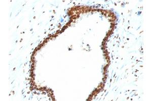 Formalin-fixed, paraffin-embedded human Colon Carcinoma stained with Double Stranded DNA Mouse Monoclonal Antibody (121-3) (dsDNA 抗体)