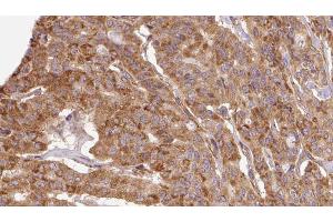 ABIN6267109 at 1/100 staining Human thyroid cancer tissue by IHC-P. (DAB1 抗体  (pTyr220))