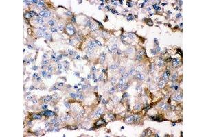 IHC-P: GFRA1 antibody testing of human lung cancer tissue (GFRA1 抗体  (AA 25-227))