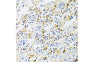 Immunohistochemistry of paraffin-embedded human liver cancer using CXCR3 Antibody. (CXCR3 抗体)