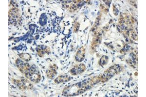 ABIN4902755 (5µg/ml) staining of paraffin embedded Human Breast cancer. (ROR1 抗体)