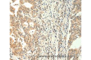 Immunohistochemistry of Human gastric cancer using TRPM5 Polyclonal Antibody at dilution of 1:60