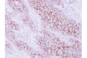 IHC-P Image Immunohistochemical analysis of paraffin-embedded human breast cancer, using KIR2DL4, antibody at 1:250 dilution. (KIR2DL4/CD158d 抗体  (Center))