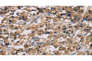 Immunohistochemistry of paraffin-embedded Human thyroid cancer tissue using hCG Polyclonal Antibody at dilution 1:65