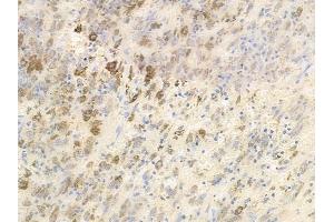 ABIN6256333 and ABIN6267441 at 1/100 staining human melanoma by IHC-P.