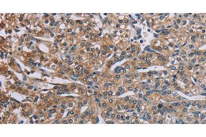 Immunohistochemistry of paraffin-embedded Human prostate cancer using PLXND1 Polyclonal Antibody at dilution of 1:40 (PLXND1 抗体)
