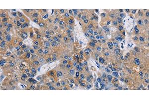Immunohistochemistry of paraffin-embedded Human liver cancer using GPM6A Polyclonal Antibody at dilution of 1:40 (GPM6A 抗体)