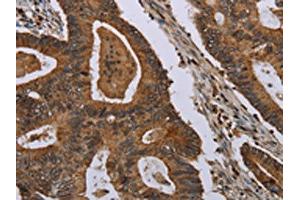 The image on the left is immunohistochemistry of paraffin-embedded Human colon cancer tissue using ABIN7191460(MIG7 Antibody) at dilution 1/35, on the right is treated with synthetic peptide. (TOX4 抗体)
