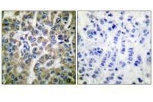 Immunohistochemical analysis of paraffin-embedded human breast carcinoma tissue using HSP10 antibody.