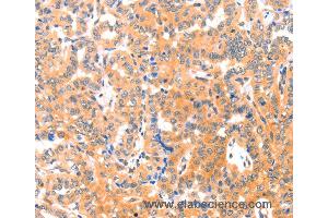 Immunohistochemistry of Human cervical cancer using THBS1 Polyclonal Antibody at dilution of 1:60 (Thrombospondin 1 抗体)