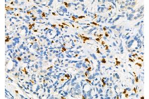 ABIN6258709 and ABIN6275128 at 1/100 staining Human pancreatic cancer and adjacent non-tumor tissue by IHC-P. (FOXD4 抗体  (Internal Region))