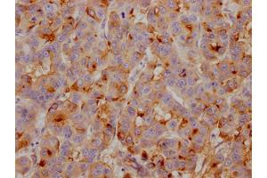 IHC image of ABIN7127430 diluted at 1:100 and staining in paraffin-embedded human breast cancer performed on a Leica BondTM system. (Recombinant Clusterin 抗体)