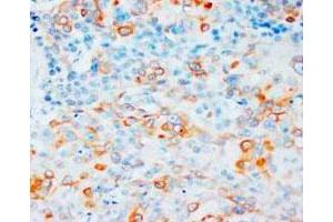 Immunohistochemical staining of VEGFA on formalin fixed, paraffin embedded human esophageal squamous cell carcinoma (ESCC) in cytoplasm DAB chromogenic reaction. (VEGFA 抗体  (N-Term))