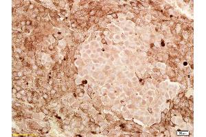 Formalin-fixed and paraffin embedded human melanoma labeled with Anti-CITED1/ABCC1 Polyclonal Antibody, Unconjugated (ABIN682543) at 1:200, followed by conjugation to the secondary antibody and DAB staining (CITED1 抗体  (AA 121-193))