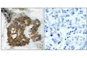 Immunohistochemical analysis of paraffin-embedded human lung carcinoma tissue using Akt2 (phospho- Ser474) antibody (E011124). (AKT2 抗体  (pSer474))