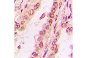 Immunohistochemical analysis of PPHLN1 staining in human breast cancer formalin fixed paraffin embedded tissue section. (PPHLN1 抗体  (Center))