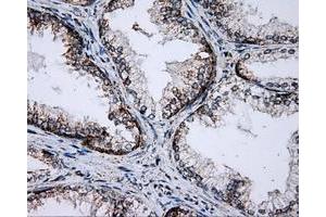 Immunohistochemical staining of paraffin-embedded Adenocarcinoma of breast tissue using anti-PTPRE mouse monoclonal antibody. (PTPRE 抗体)