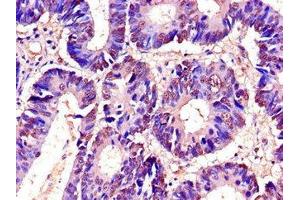 Immunohistochemistry of paraffin-embedded human colon cancer using ABIN7173542 at dilution of 1:100 (C22orf28 抗体  (AA 52-229))