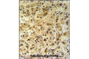 GNS Antibody (Center ) (ABIN390494 and ABIN2840853) IHC analysis in formalin fixed and paraffin embedded human hepatocarcinoma followed by peroxidase conjugation of the secondary antibody and DAB staining. (GNS 抗体  (AA 174-203))