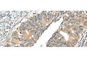 Immunohistochemistry of paraffin-embedded Human colorectal cancer tissue using AIFM2 Polyclonal Antibody at dilution of 1:40(x200) (AIFM2 抗体)