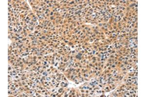 The image on the left is immunohistochemistry of paraffin-embedded Human lung cancer tissue using ABIN7129182(DDX4 Antibody) at dilution 1/20, on the right is treated with fusion protein. (DDX4 抗体)