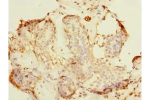 Immunohistochemistry of paraffin-embedded human breast cancer using ABIN7161600 at dilution of 1:100 (NIF3L1 抗体  (AA 1-377))