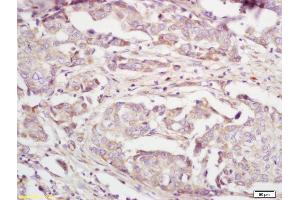 Formalin-fixed and paraffin embedded human breast carcinoma labeled with Anti-IL-22BP Polyclonal Antibody, Unconjugated (ABIN748193) at 1:200 followed by conjugation to the secondary antibody and DAB staining. (IL22RA2 抗体  (AA 165-263))