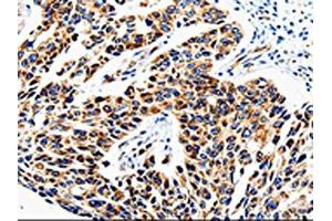 The image is immunohistochemistry of paraffin-embedded Human lung cancer tissue using ABIN7129010(COX16 Antibody) at dilution 1/50. (COX16 抗体)