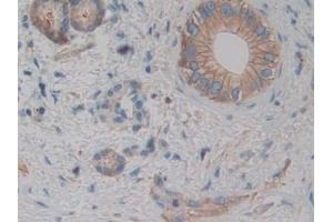 Detection of ACTN4 in Human Bile duct cancer Tissue using Polyclonal Antibody to Actinin Alpha 4 (ACTN4) (alpha Actinin 4 抗体  (AA 1-269))