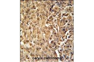 ZC3HAV1 Antibody (C-term) (ABIN651882 and ABIN2840438) immunohistochemistry analysis in formalin fixed and paraffin embedded human cervix carcinoma followed by peroxidase conjugation of the secondary antibody and DAB staining. (ZC3HAV1 抗体  (C-Term))