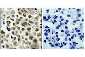 Immunohistochemical analysis of paraffin-embedded human lung carcinoma tissue using HDAC8(Phospho-Ser39) Antibody(left) or the same antibody preincubated with blocking peptide(right). (HDAC8 抗体  (pSer39))