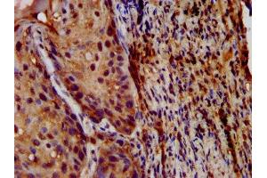 IHC image of ABIN7158410 diluted at 1:200 and staining in paraffin-embedded human lung cancer performed on a Leica BondTM system. (LIPH 抗体  (AA 175-325))