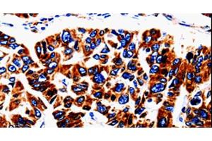 Immunohistochemistry of paraffin-embedded Human lung cancer tissue using UTS2 Polyclonal Antibody at dilution 1:50 (Urotensin 2 抗体)