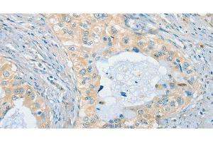 Immunohistochemistry of paraffin-embedded Human cervical cancer using CHRNA2 Polyclonal Antibody at dilution of 1:40 (CHRNA2 抗体)