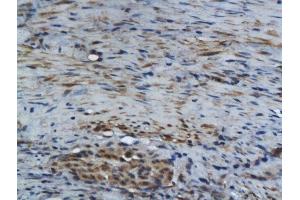 Formalin-fixed and paraffin embedded human colon carcinoma labeled with Rabbit Anti GM-CSF Polyclonal Antibody, Unconjugated  at 1:200 followed by conjugation to the secondary antibody and DAB staining (GM-CSF 抗体  (AA 65-144))