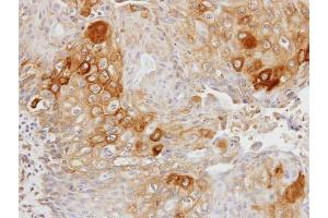 IHC-P Image Immunohistochemical analysis of paraffin-embedded OVCA xenograft, using Glycerol kinase 2, antibody at 1:100 dilution. (GK2 抗体)